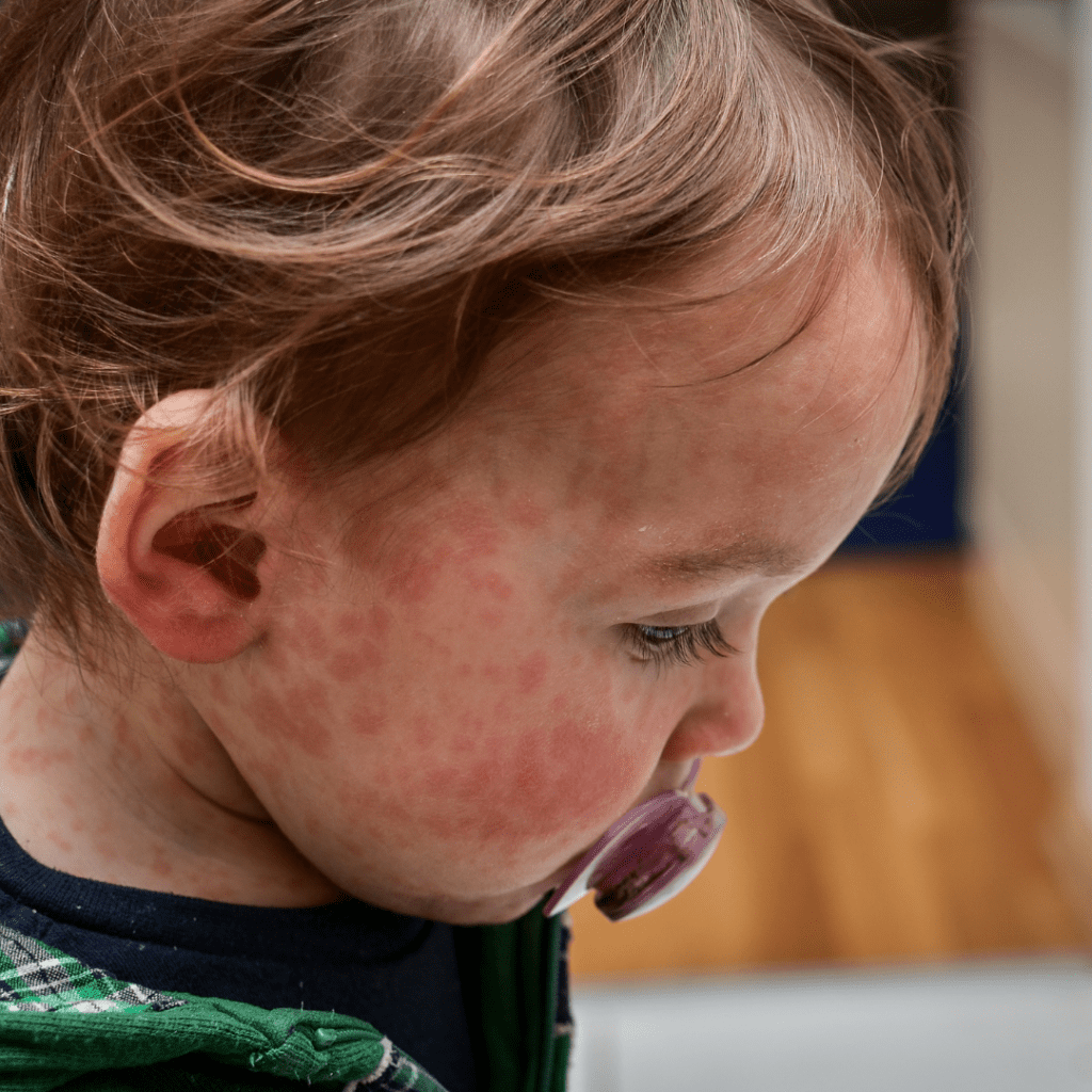 Young child with Measles rash.